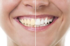 Causes of Yellow Teeth and How to Fix Them