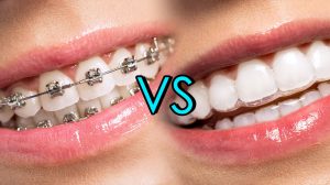 Why Orthodontics Invisalign Teeth Alignment Is Gaining Popularity
