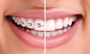 Choosing the Right Orthodontic Treatment in Islamabad
