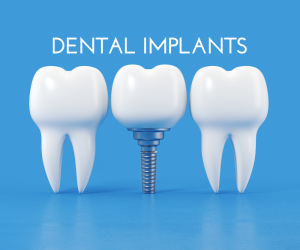 Why Choose Radiant Smile for Dental Implants